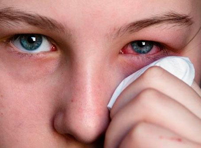 ¿Cómo actuar ante la conjuntivitis?